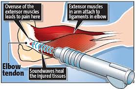 Terapia equipamento ondas de choque da onda de choque do alívio das dores da inquietação ESWT do tratamento do cotovelo de tênis de Smartwave