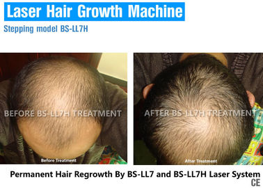 Terapia de baixo nível do laser para o crescimento do cabelo