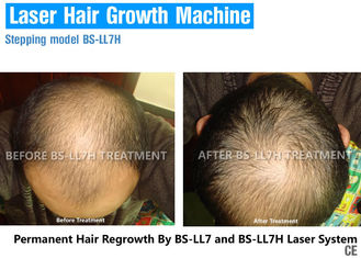 Terapia vertical do laser da luminosidade reduzida para a queda de cabelo, tratamento do laser para a calvície