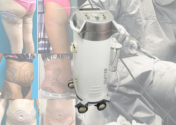 Máquina cirúrgica da lipoaspiração de Abdominoplasty da cirurgia plástica para a cirurgia da lipoaspiração da dobra/estômago da barriga