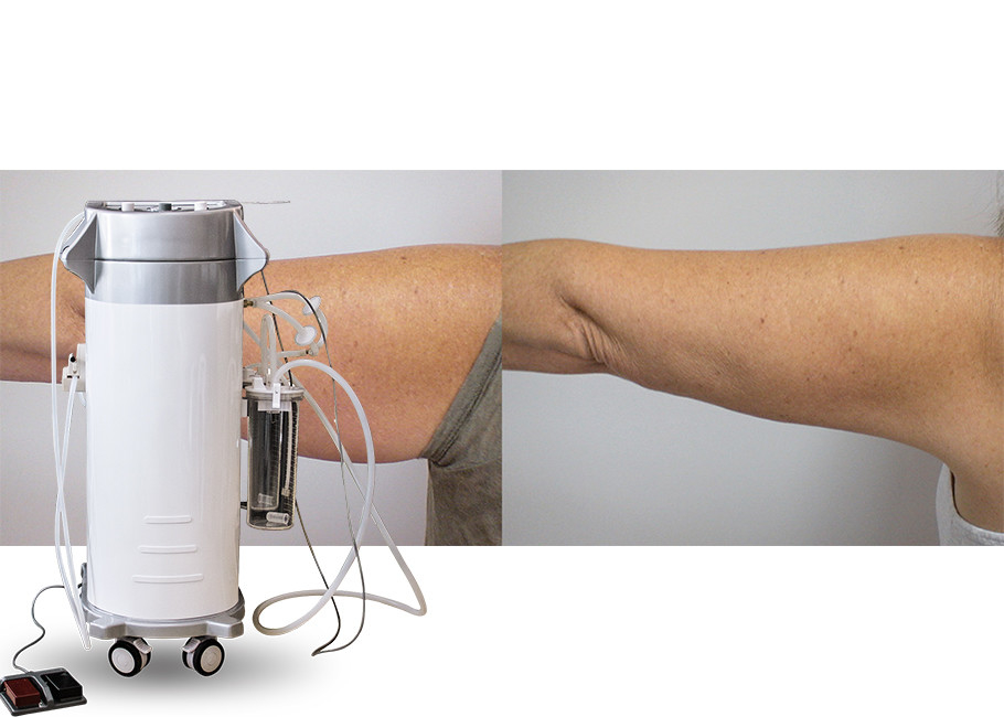 O poder ajudou à máquina cirúrgica da cavitação da lipoaspiração do vácuo para coxas/braços/tratamento traseiro