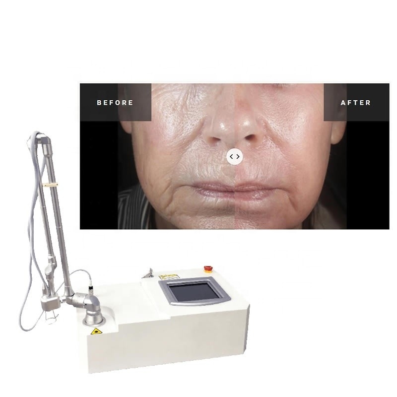 Máquina cirúrgica do laser da cicatriz da acne fracionária portátil do CO2 15w